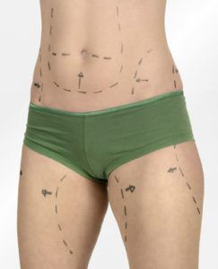 kredit fuer plastische chirurgie